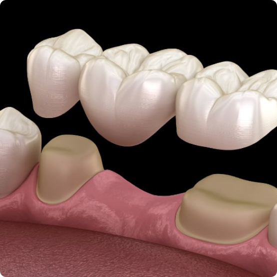 Dental Bridges